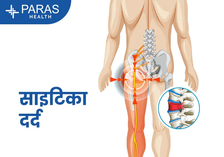 सायटिका